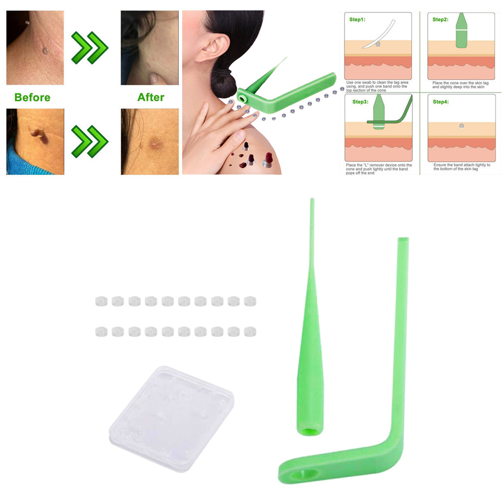 Skin Tag Removal Device Kit Effective Skin Tags Removal Green