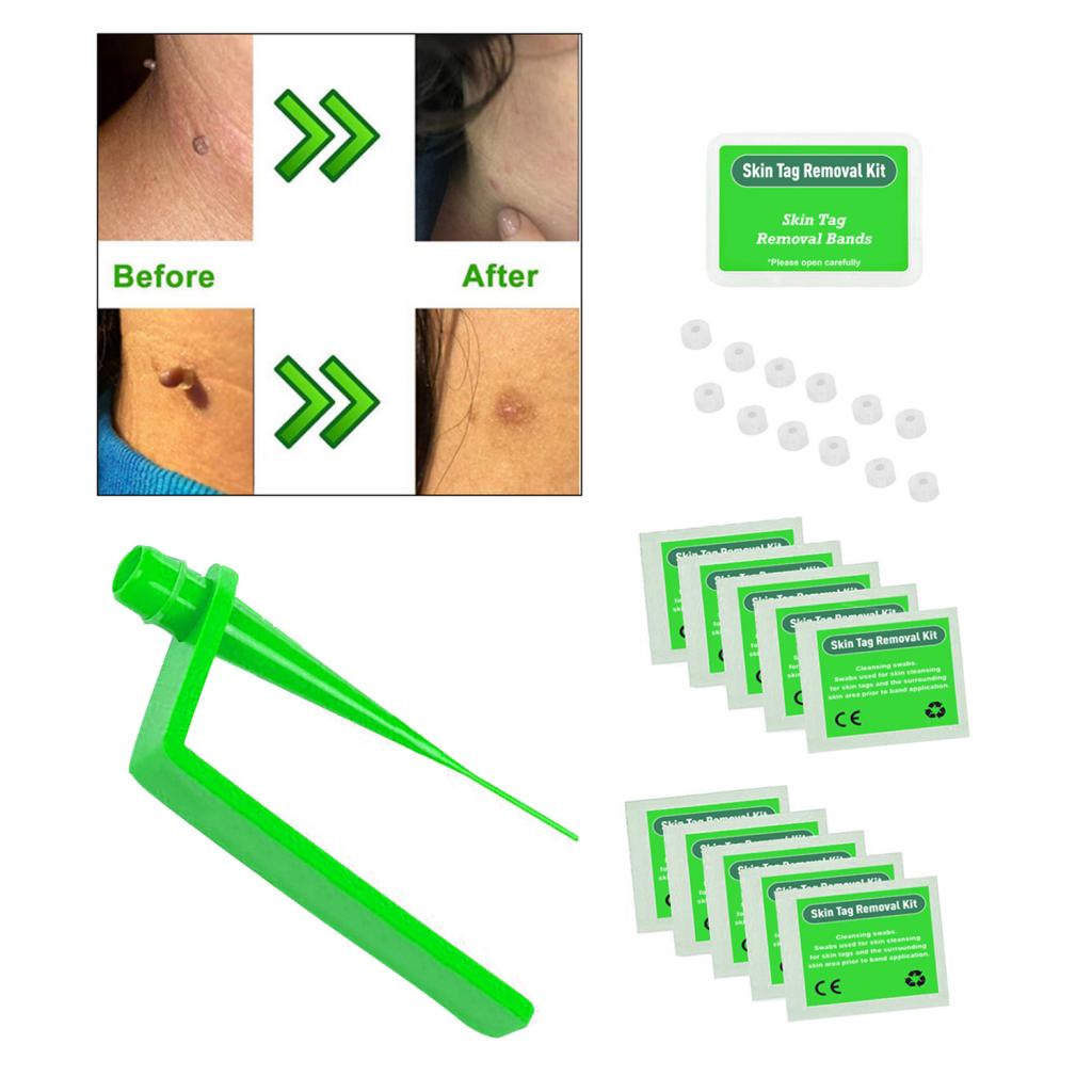 Skin Tag Removal Device Kit Effective Skin Tags Removal Green